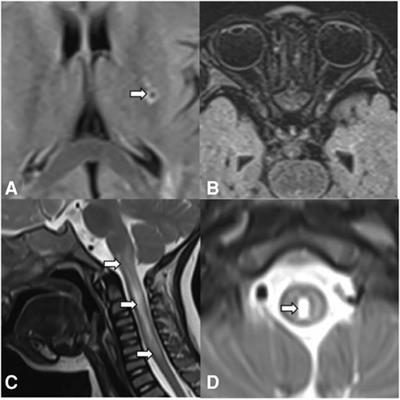 Case report: COPA syndrome with interstitial lung disease, skin involvement, and neuromyelitis spectrum disorder